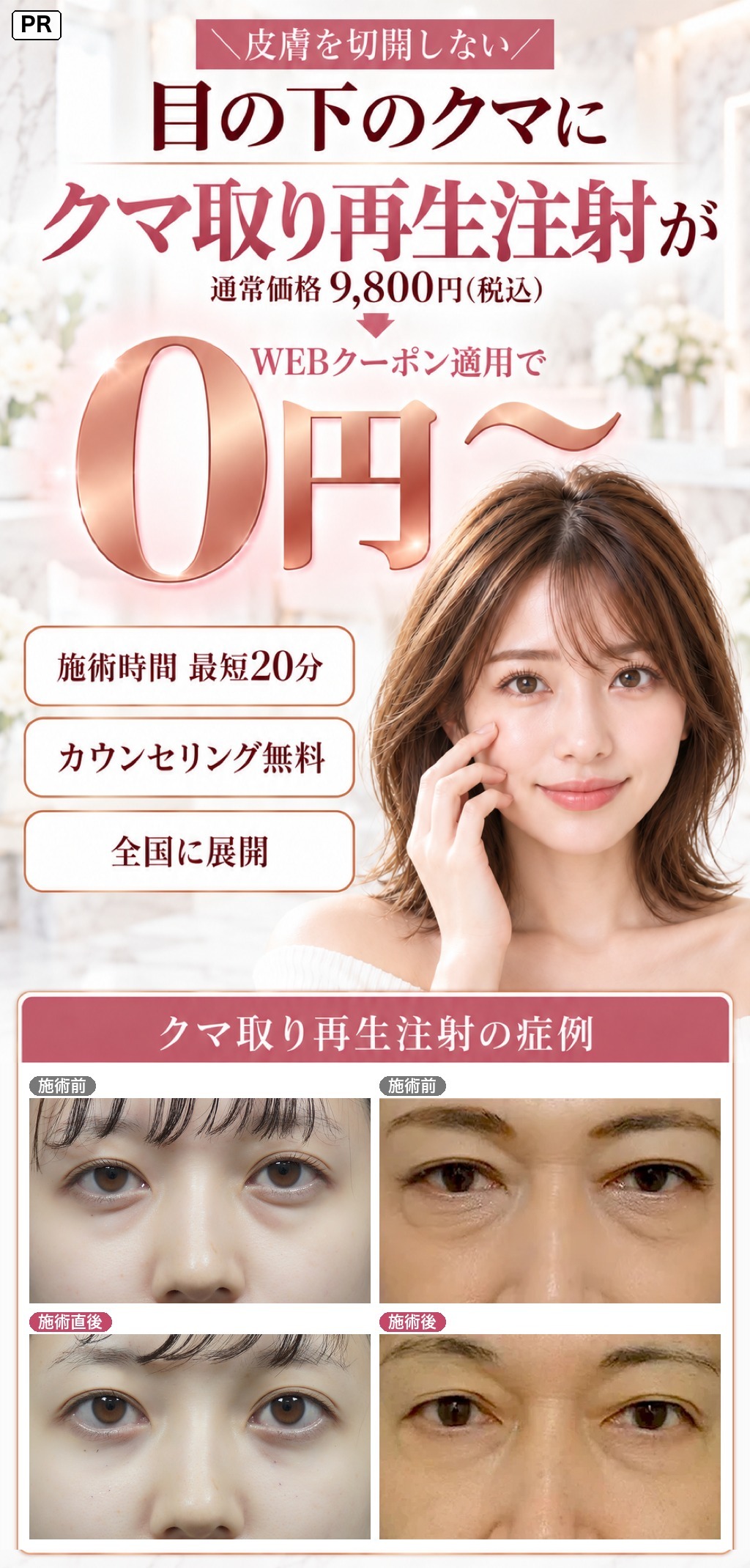皮膚を切開しない 目の下のクマに クマ取り再生注射が 通常価格9,800円(税込) WEBクーポン適用で0円〜。クマ取り再生注射の症例